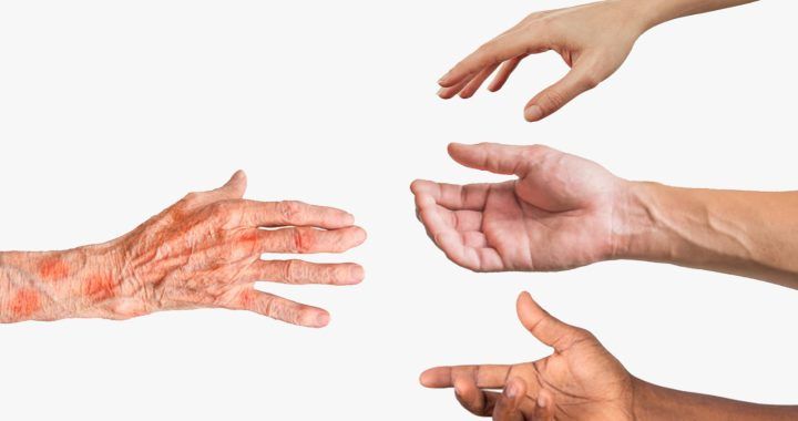 Kasus Kusta Anak dan Cacat Tingkat Dua Masih Ditemukan, Dinkes Gorontalo Ingatkan Pentingnya Deteksi Dini dan Penghapusan Stigma